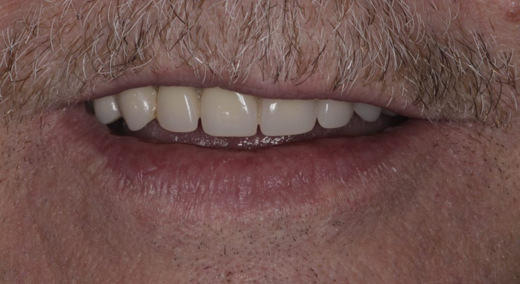 Man with an obturator