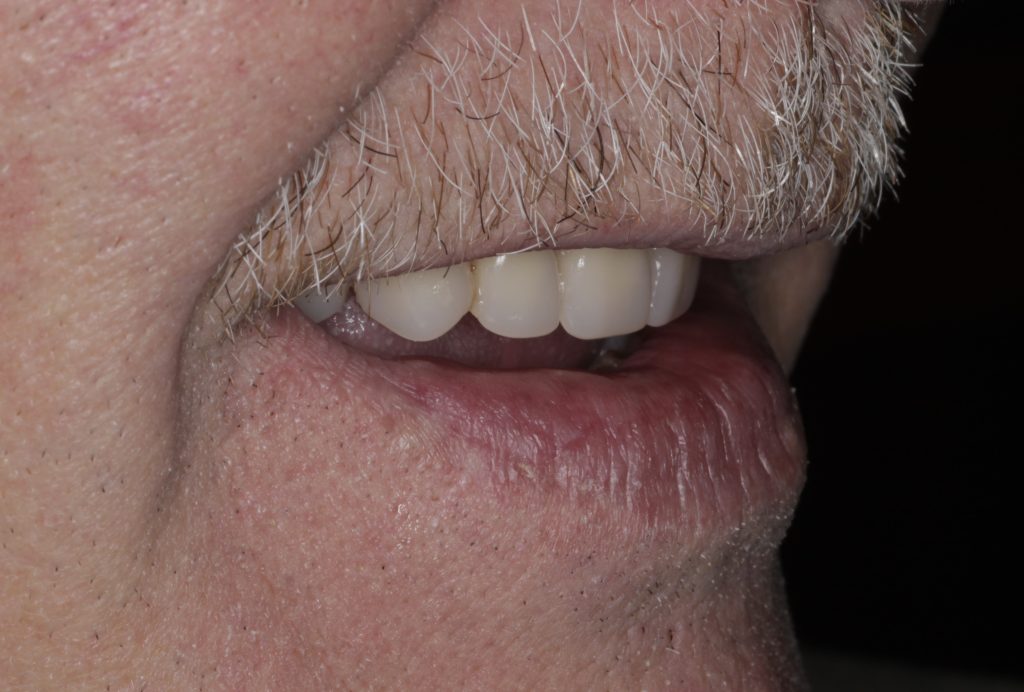 Man with an obturator