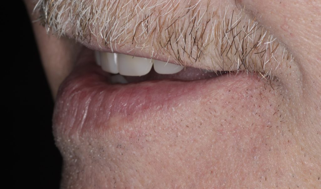 Man with an obturator