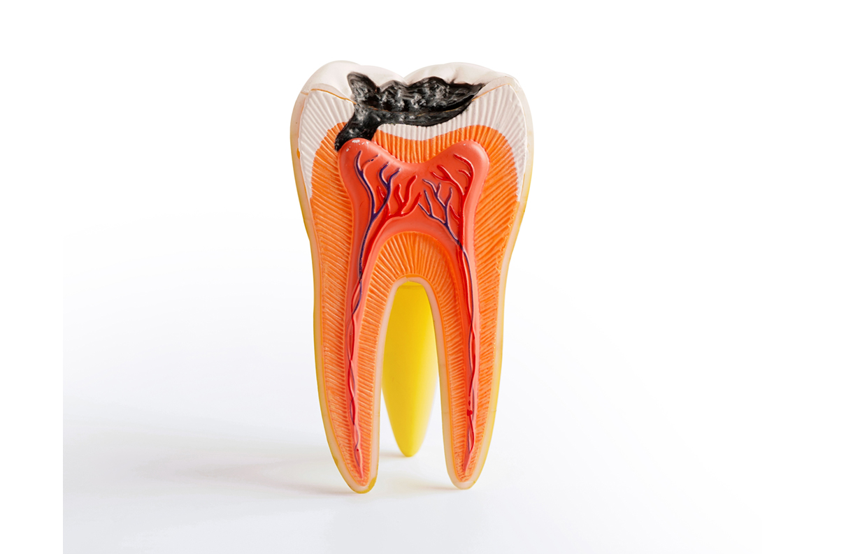 3D dental illustration showing severe dental caries